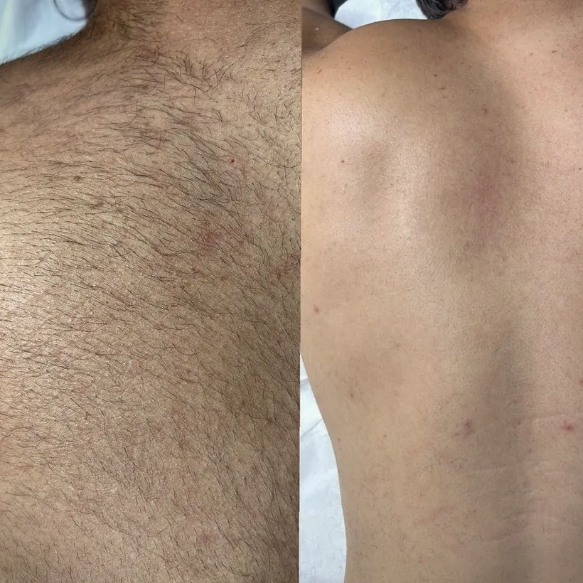 Antes e depois de depilação a laser na região das costas