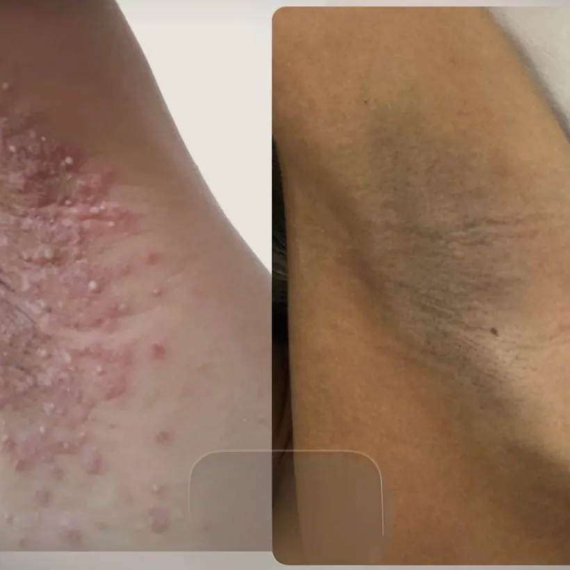 Antes e depois: melhora de foliculite em axila após depilação a laser