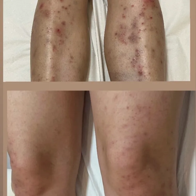 Antes e depois: pernas após protocolo de depilação a laser