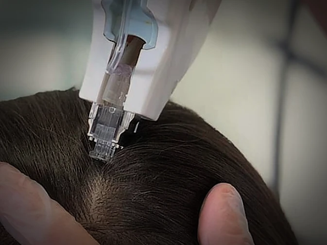 Mesoject Gun em aplicação no couro cabeludo