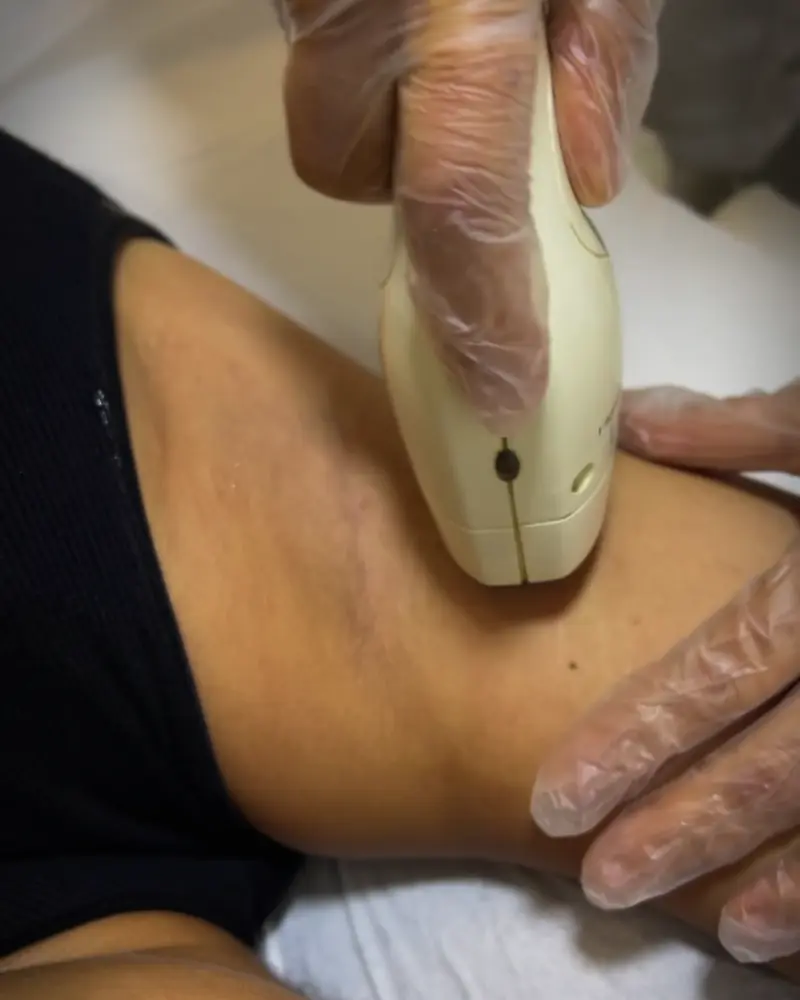 Aplicação de laser em axila, com óculos de proteção
